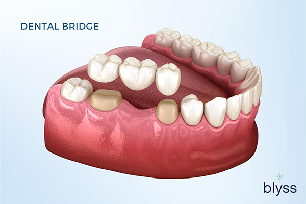 3D digital illustration of dental bridge