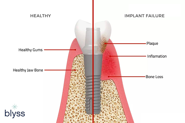 comparison of successful implant treatment and dental implant failure