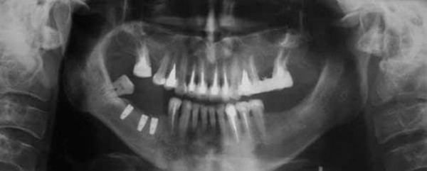 an x-ray result of jawbone loss