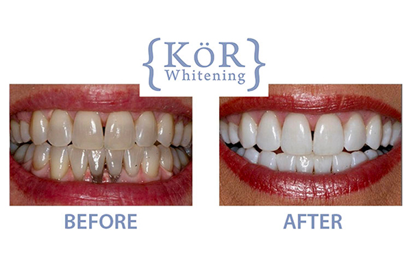 KöR Whitening before and after results 