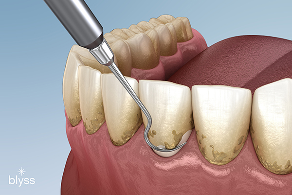 3D illustration of teeth scaling