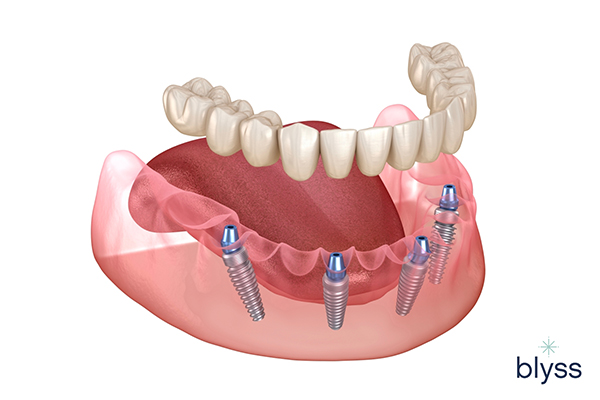 3D illustration of all-on-4 dental implants