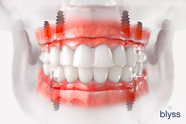 3D illustration of full-mouth dental prosthesis