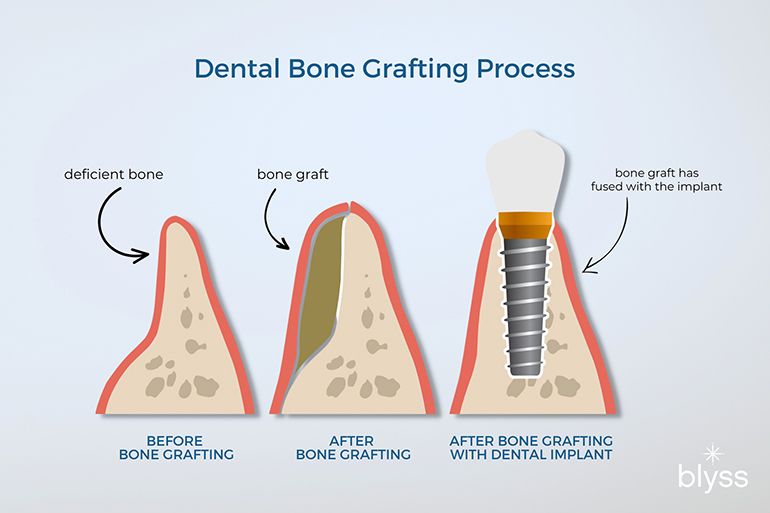 2D infographic of the dental bone grafting process