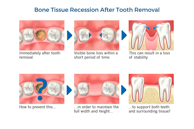 infographic of bone tissue recession after tooth removal