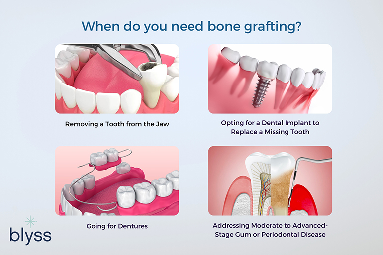 when do you need bone grafting infographic 