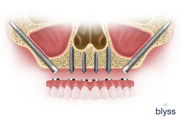 3D illustration of zygomatic implants 