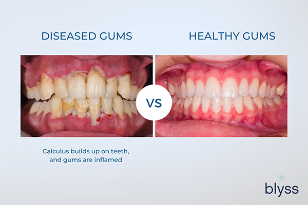diseased gums vs healthy gums infographics 