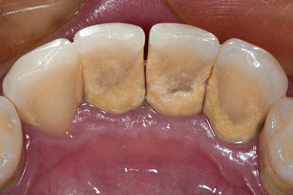 teeth with dental plaque