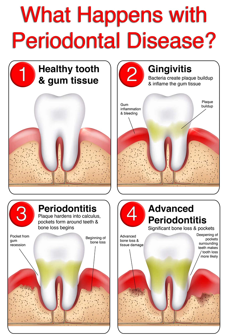 gum disease stages infographic