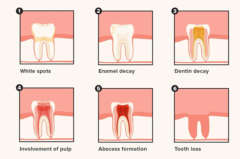 2D illustration of the stages of tooth decay
