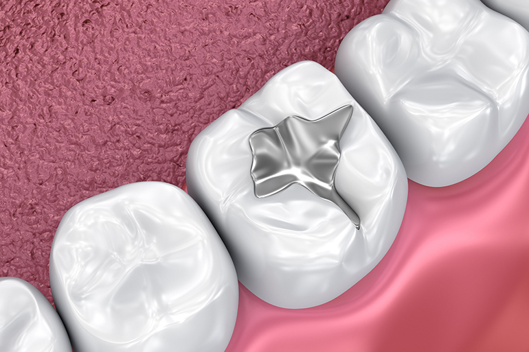 3D illustration of a tooth with amalgam dental filling