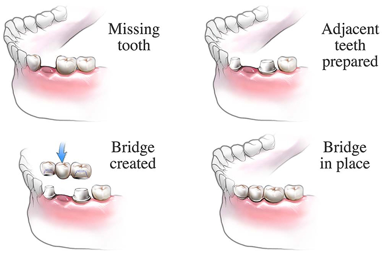 2D illustration of dental bridge procedure