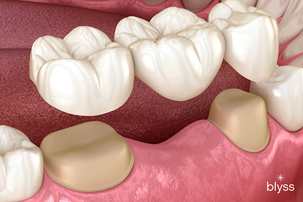 3D illustration of traditional dental bridge