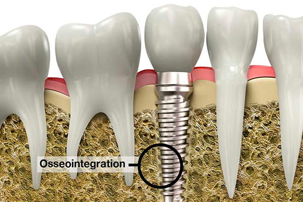 3D Illustration of Osseointegration of a Dental Implant