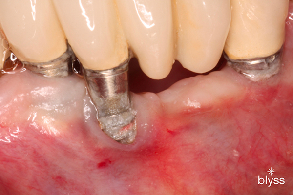 close-up image of plaque build-up on implant post