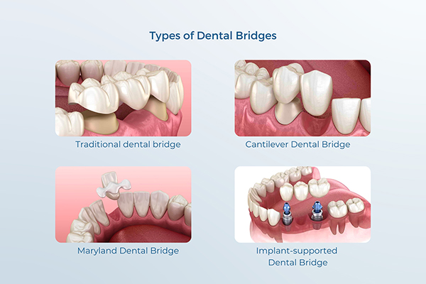 3D illustrations of the four types of dental bridges