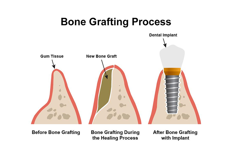 2D illustration of bone grafting process 