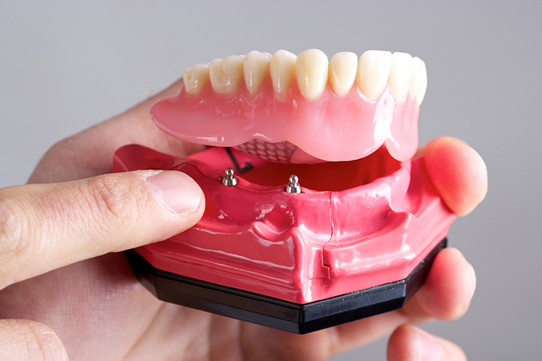 set of artificial teeth with an implant and dental prosthesis