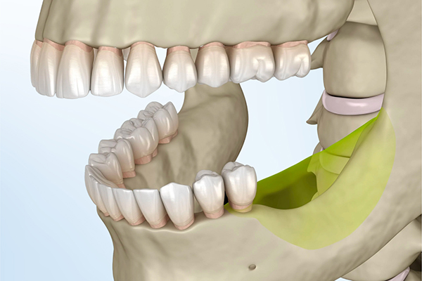 3D illustration of jawbone loss