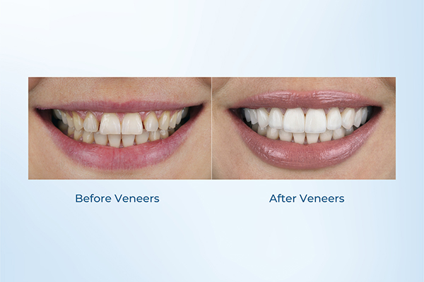 close-up comparison of teeth before and after dental veneers