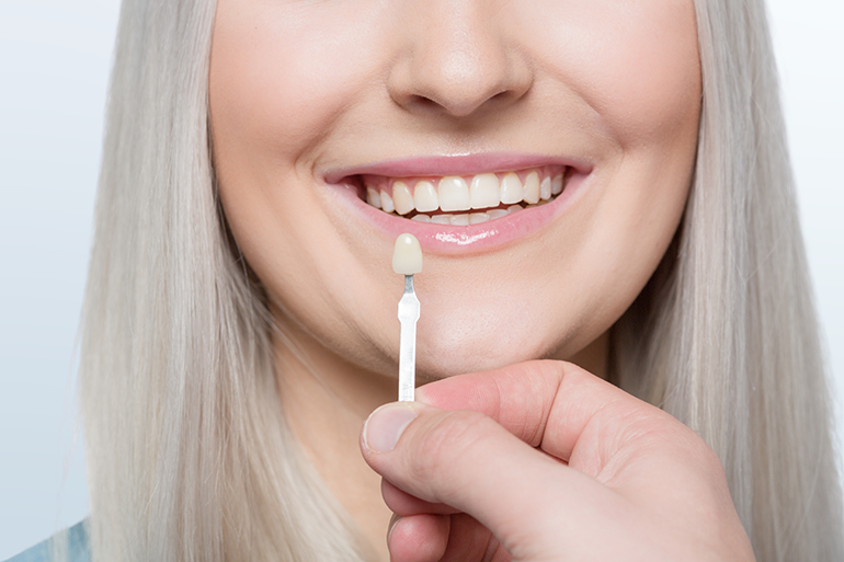 woman smiling with dental veneer