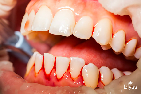 close up image of bleeding gums