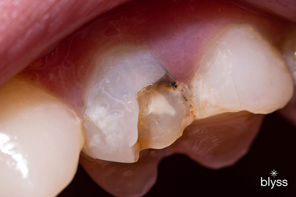 close up image of chipped tooth