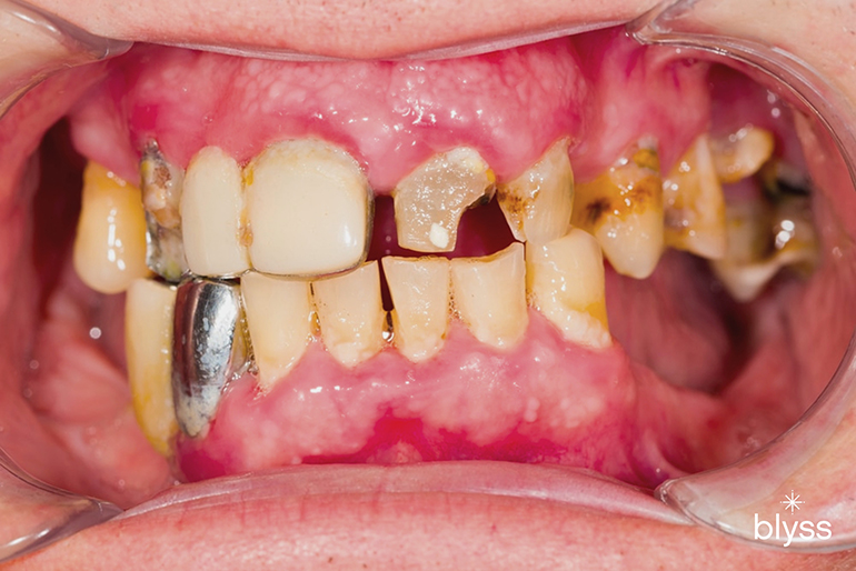 close up image of teeth with multiple dental issues