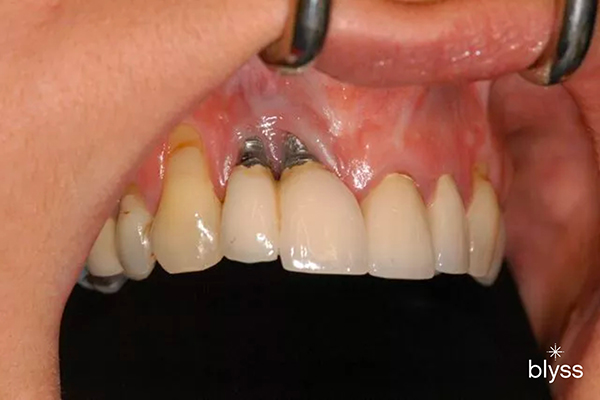 close up image of upper teeth with failed dental implants