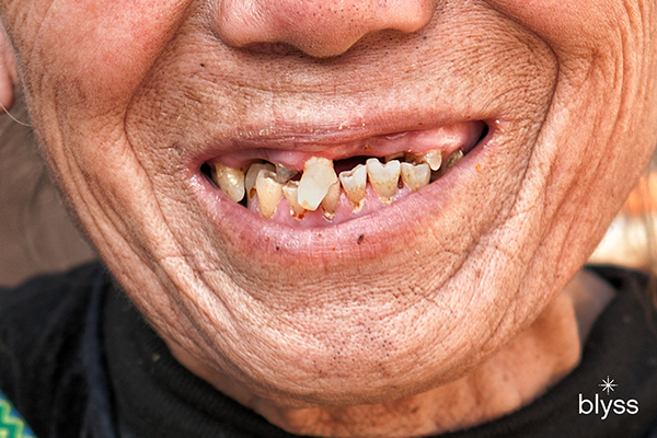 female senior smiling with missing teeth