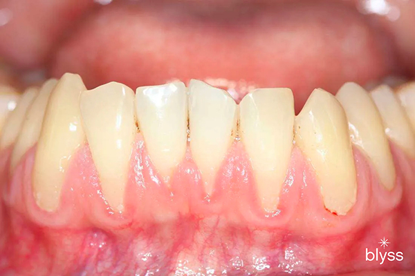 close up image of lower tooth showing receding gums