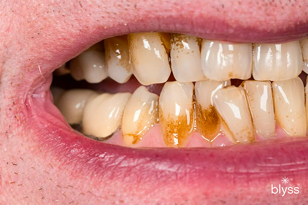 close up image of stains on teeth