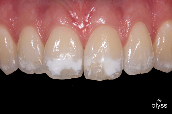 close up image of white spots on teeth