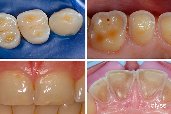 four cases of worn teeth