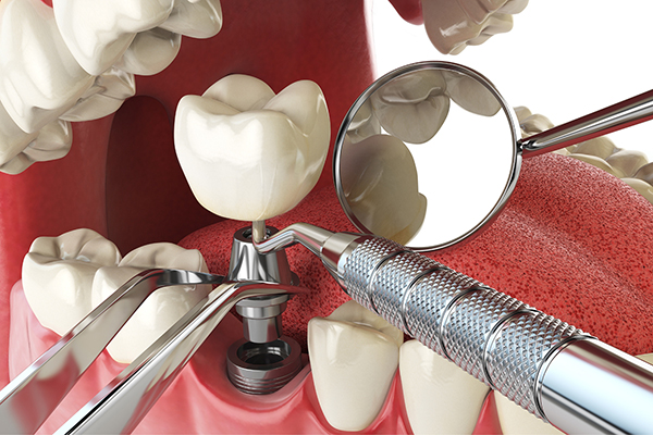 3D illustration of dental implants on the mouth