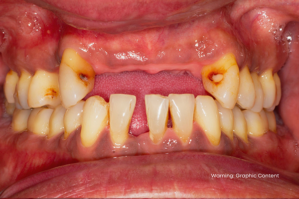 graphic image of tooth loss cause by gum disease