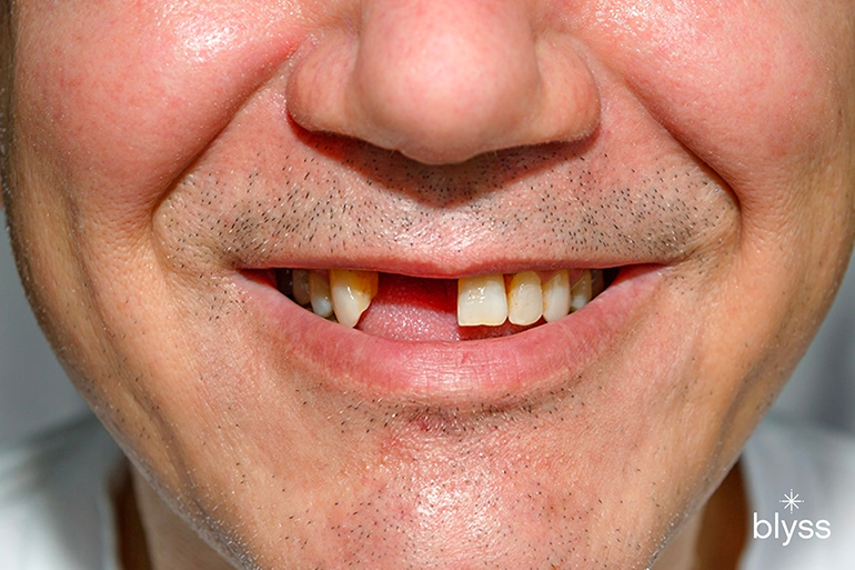 close-up image of man with missing front teeth