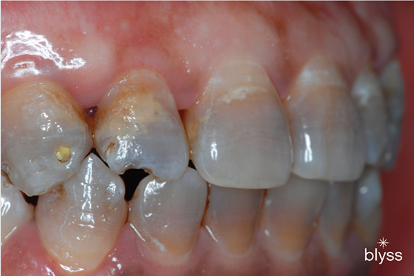 close up image of tetracycline stains on teeth