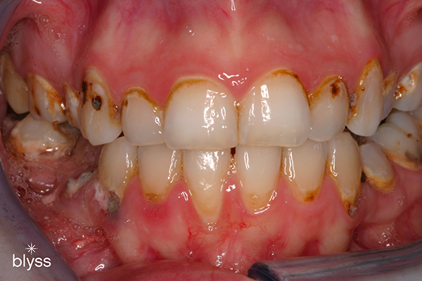 close up image of heavily damaged teeth due to smoking 